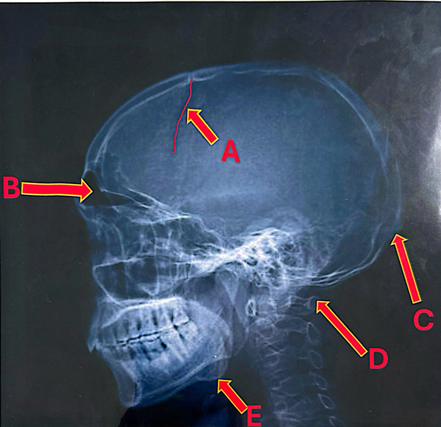 Case 1: Rumi's Head Trauma