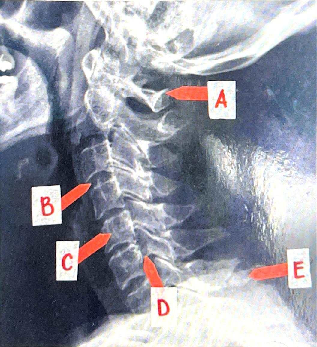 Case 3: Abby Saja's Weightlifting Injury