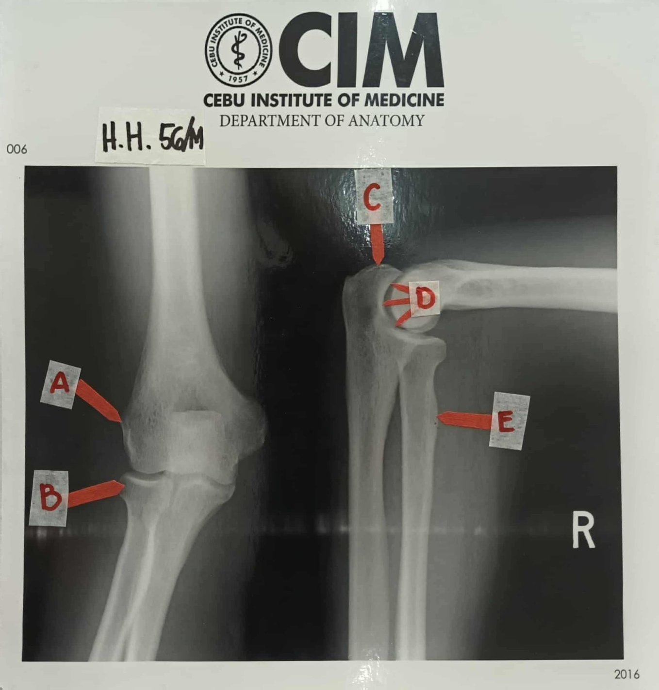 Case 5: Healer Han's Pickleball Elbow