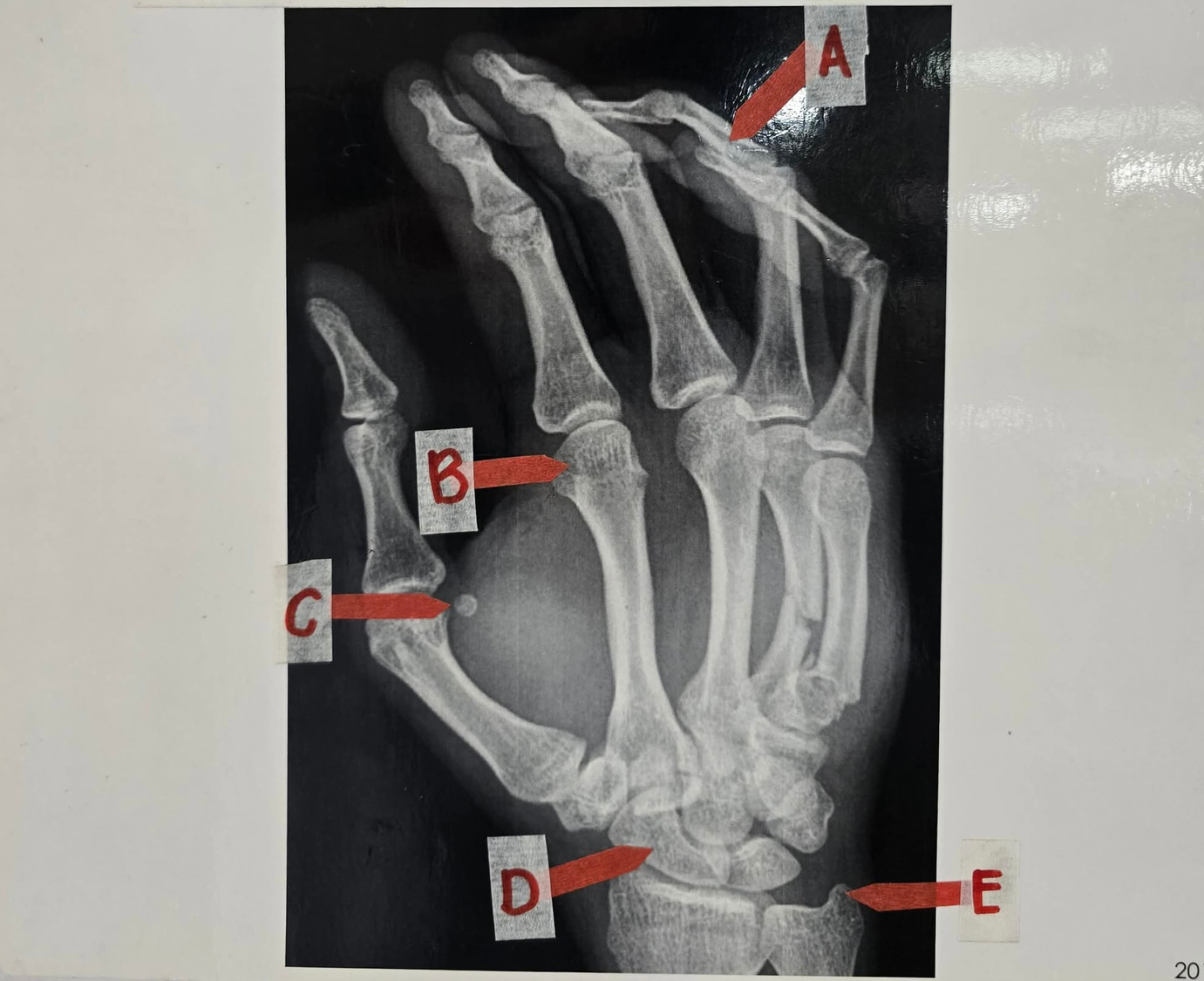 Case 6: Baby Saja's Wall Punching Injury