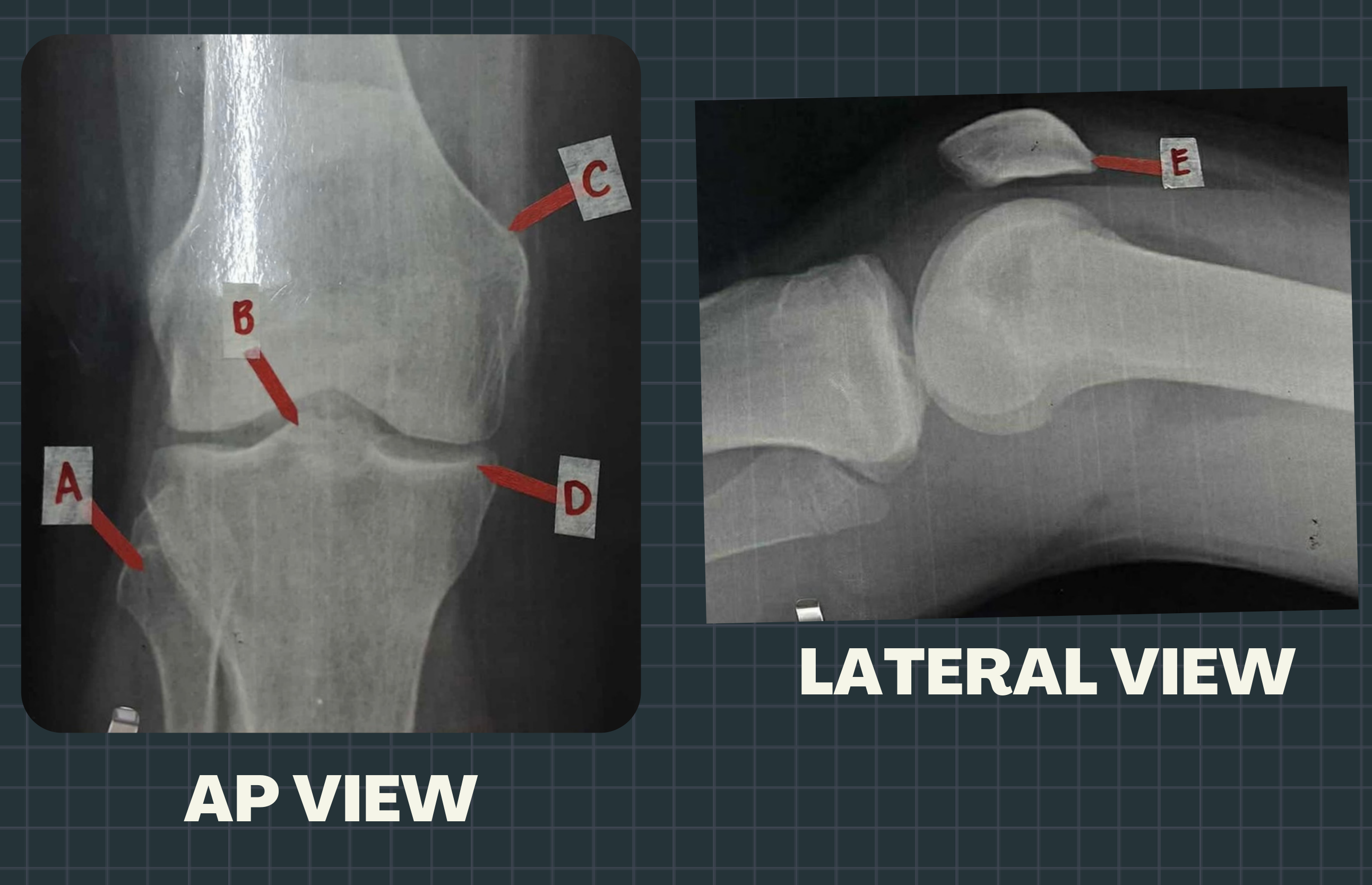 Case 8: Bobby's Organizer Knee Overuse